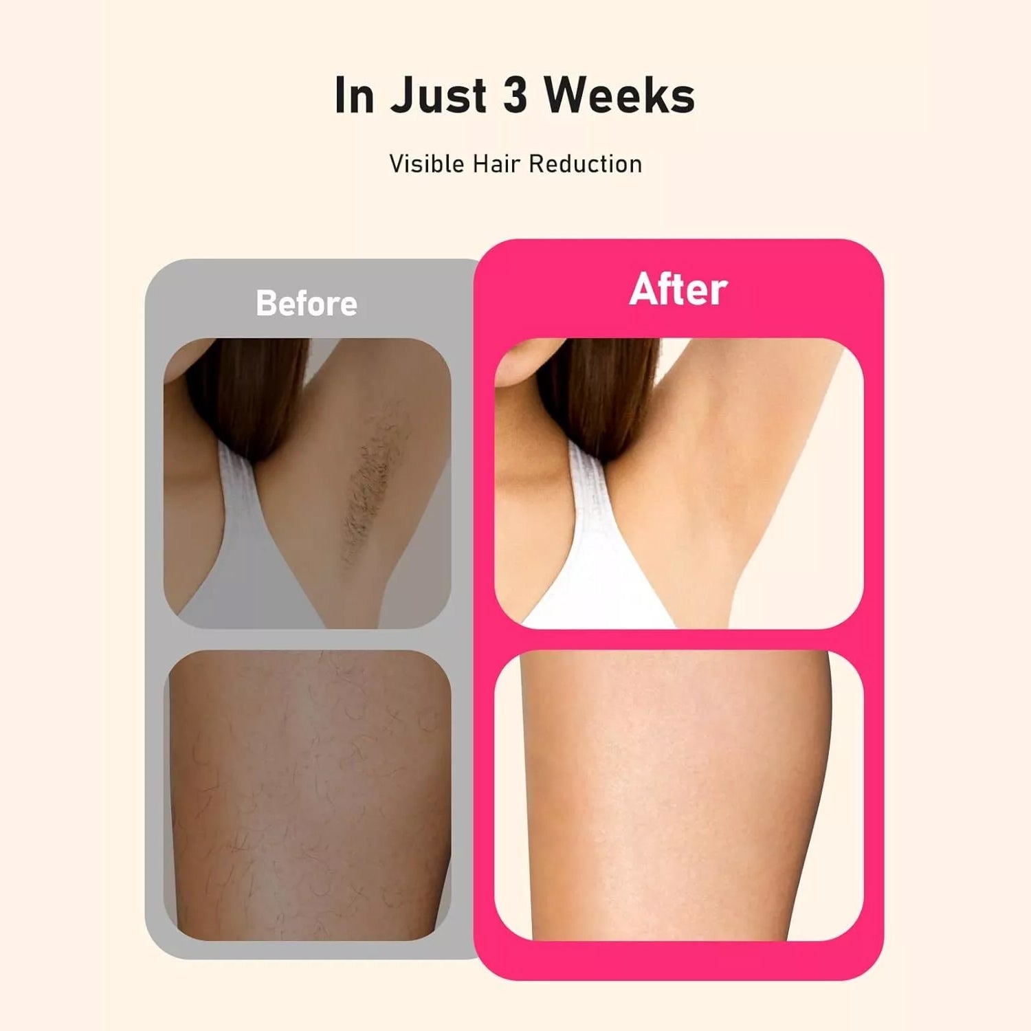 Purelazor Laser Hair Removal Device