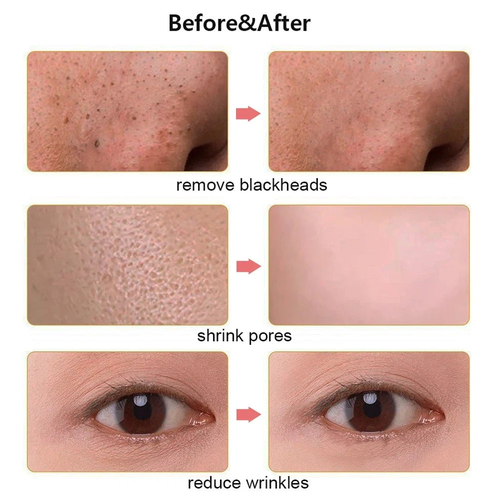 SkinSonyc v2 Ultrasonic Skin Scrubber & Pore Cleanser