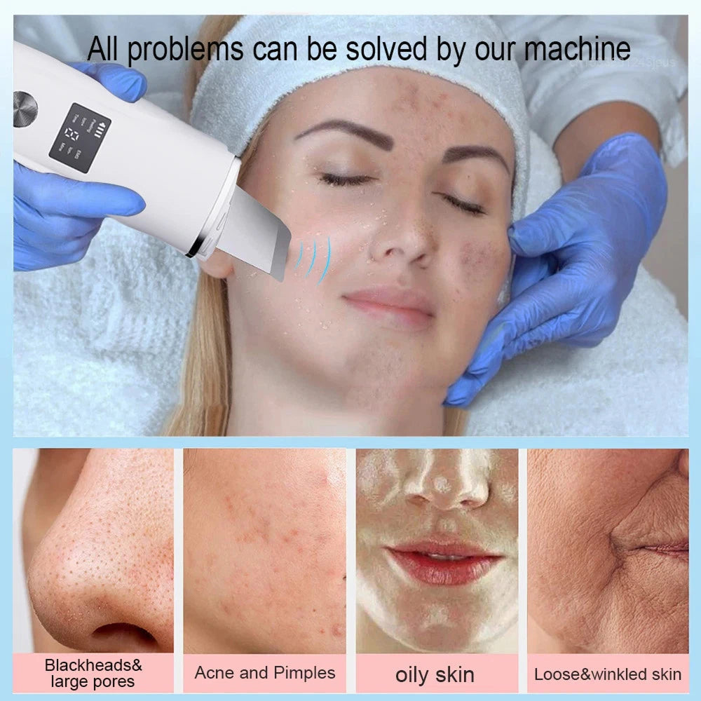 SkinSonyc v2 Ultrasonic Skin Scrubber & Pore Cleanser