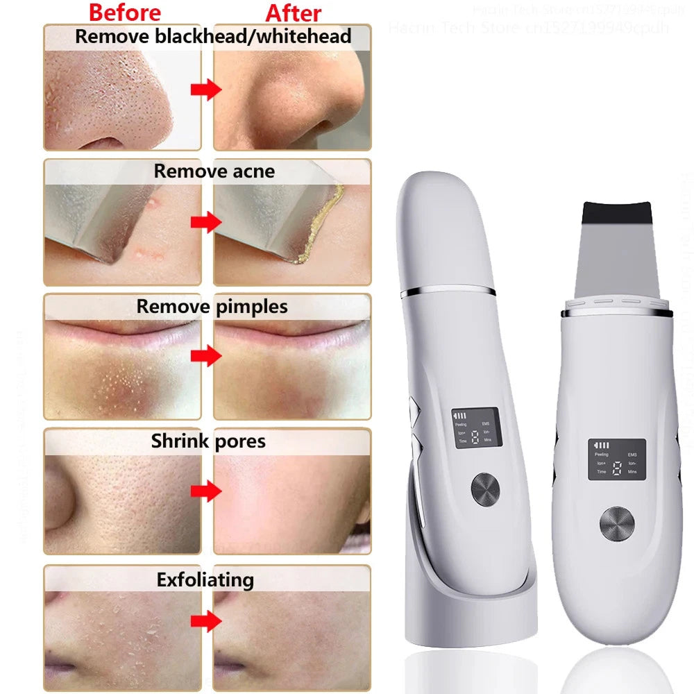 SkinSonyc v2 Ultrasonic Skin Scrubber & Pore Cleanser